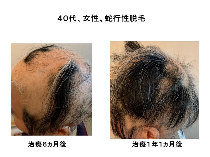 円形脱毛症　病院